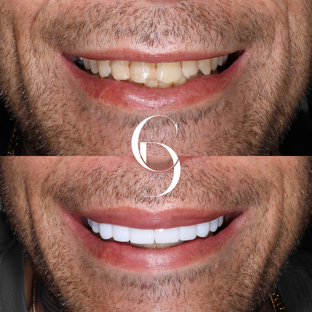Cooper's Veneers Makeover In Cosmetique Dental™