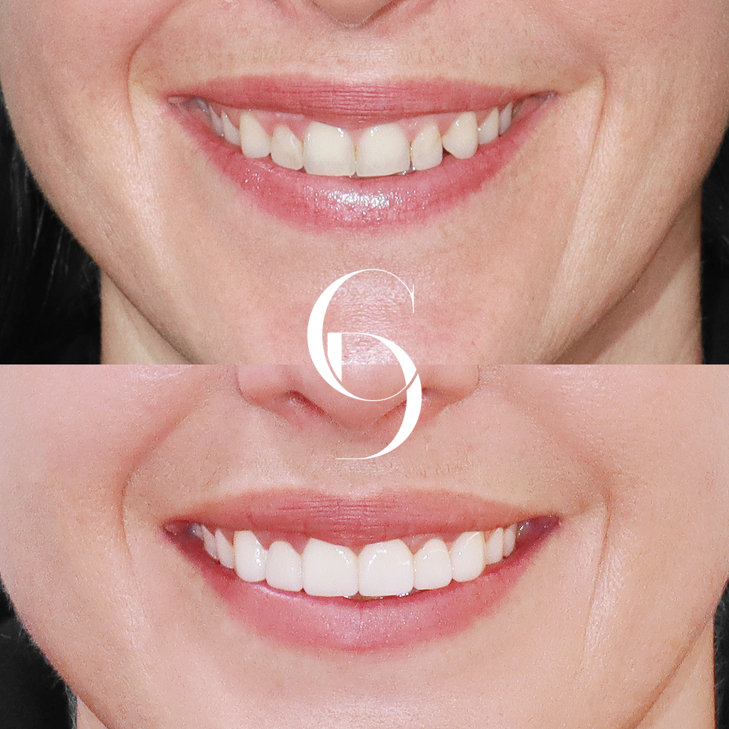 Daisy's Veneers Makeover In Cosmetique Dental™