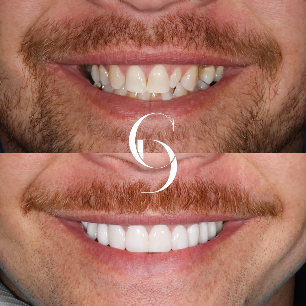 Eli's Veneers Makeover In Cosmetique Dental™