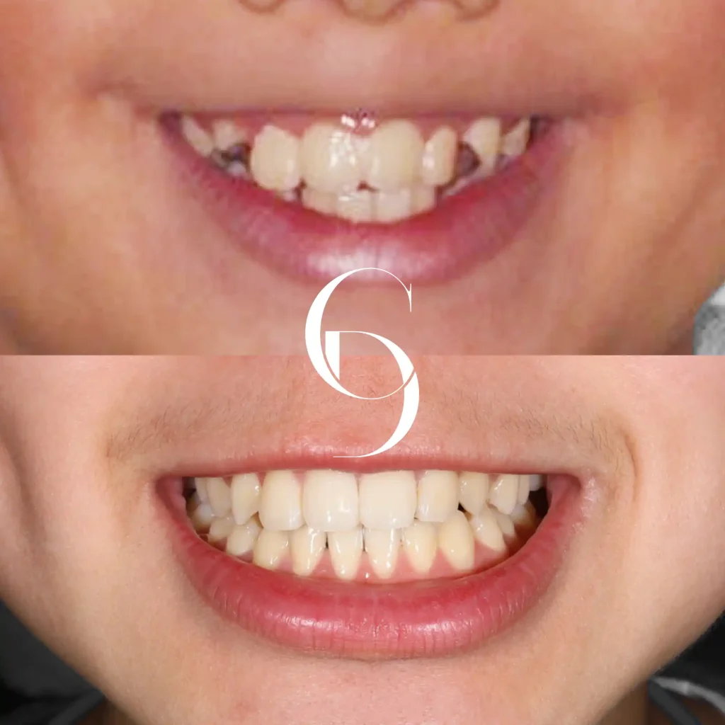 Elia’s Invisalign Makeover In Cosmetique Dental™ Elia's Invisalign Makeover In Cosmetique Dental™