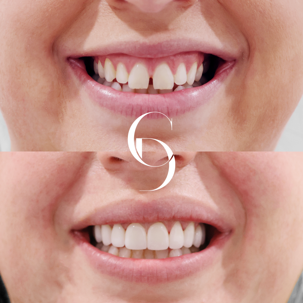 Eliza's Veneers Makeover In Cosmetique Dental™