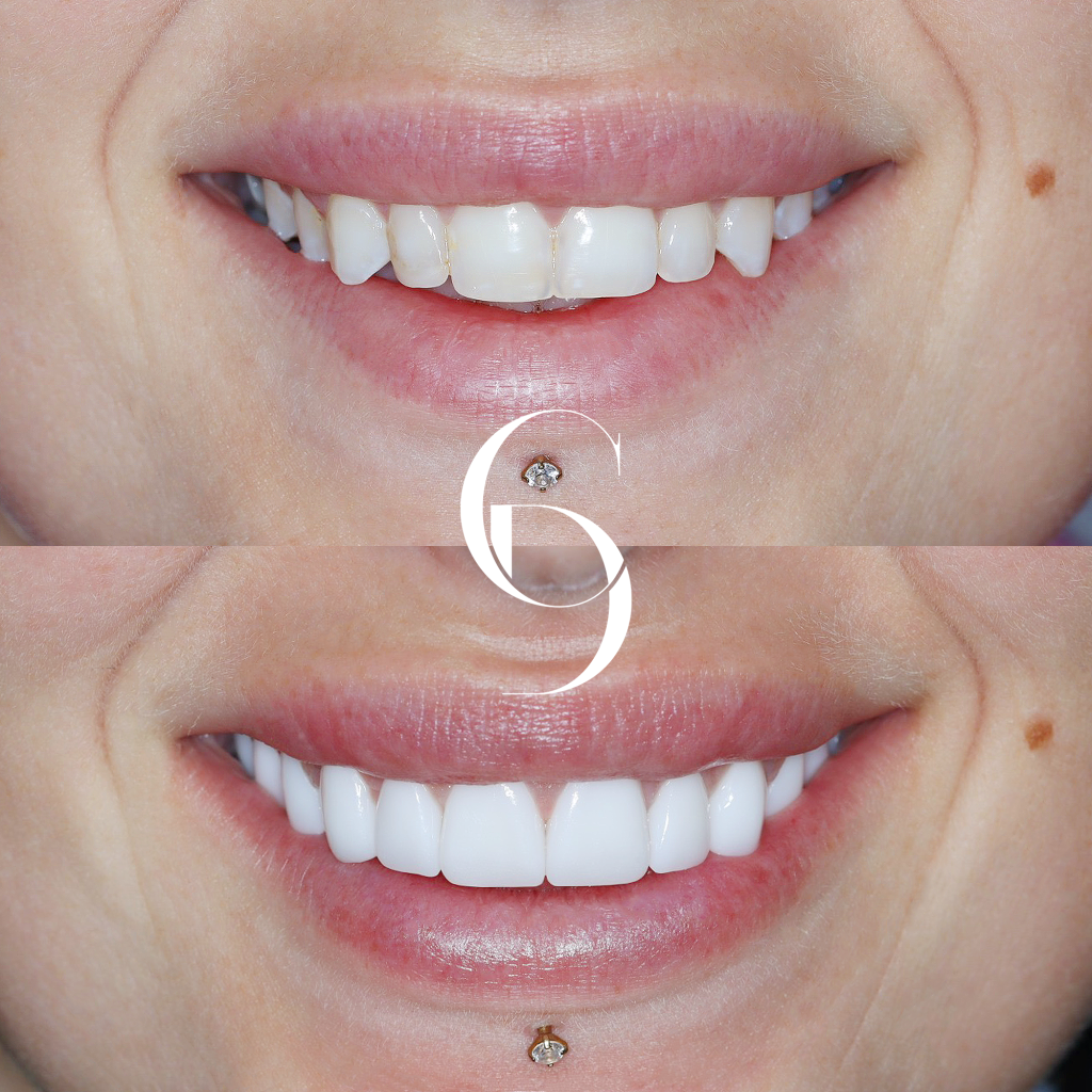 Ellie's Veneers Makeover In Cosmetique Dental™