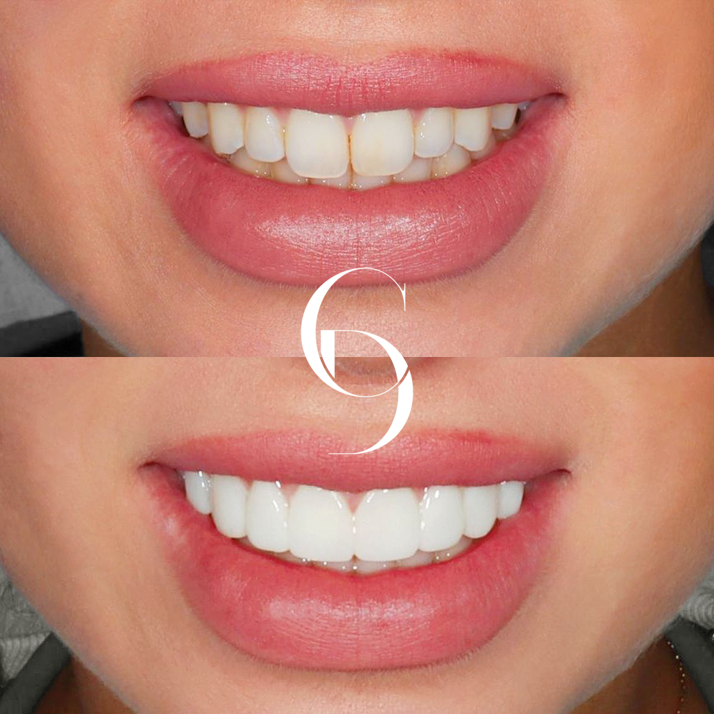 Elsie's Veneers Makeover In Cosmetique Dental™