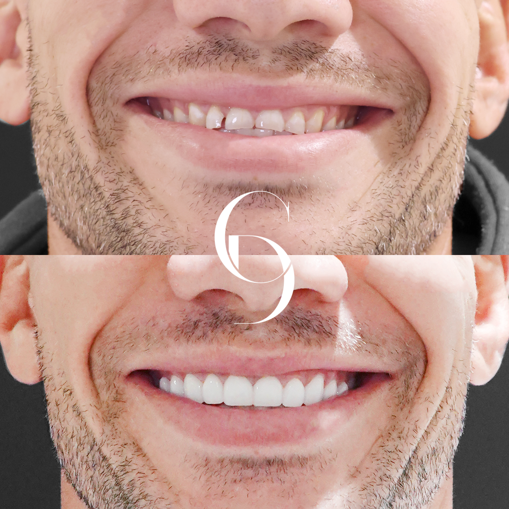 Ethan's Veneers Makeover In Cosmetique Dental™