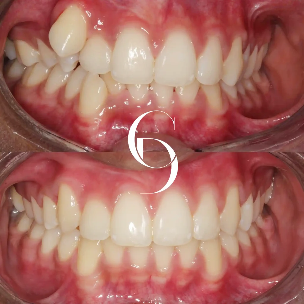 Eve’s Invisalign Makeover In Cosmetique Dental™ Eve's Invisalign Makeover In Cosmetique Dental™
