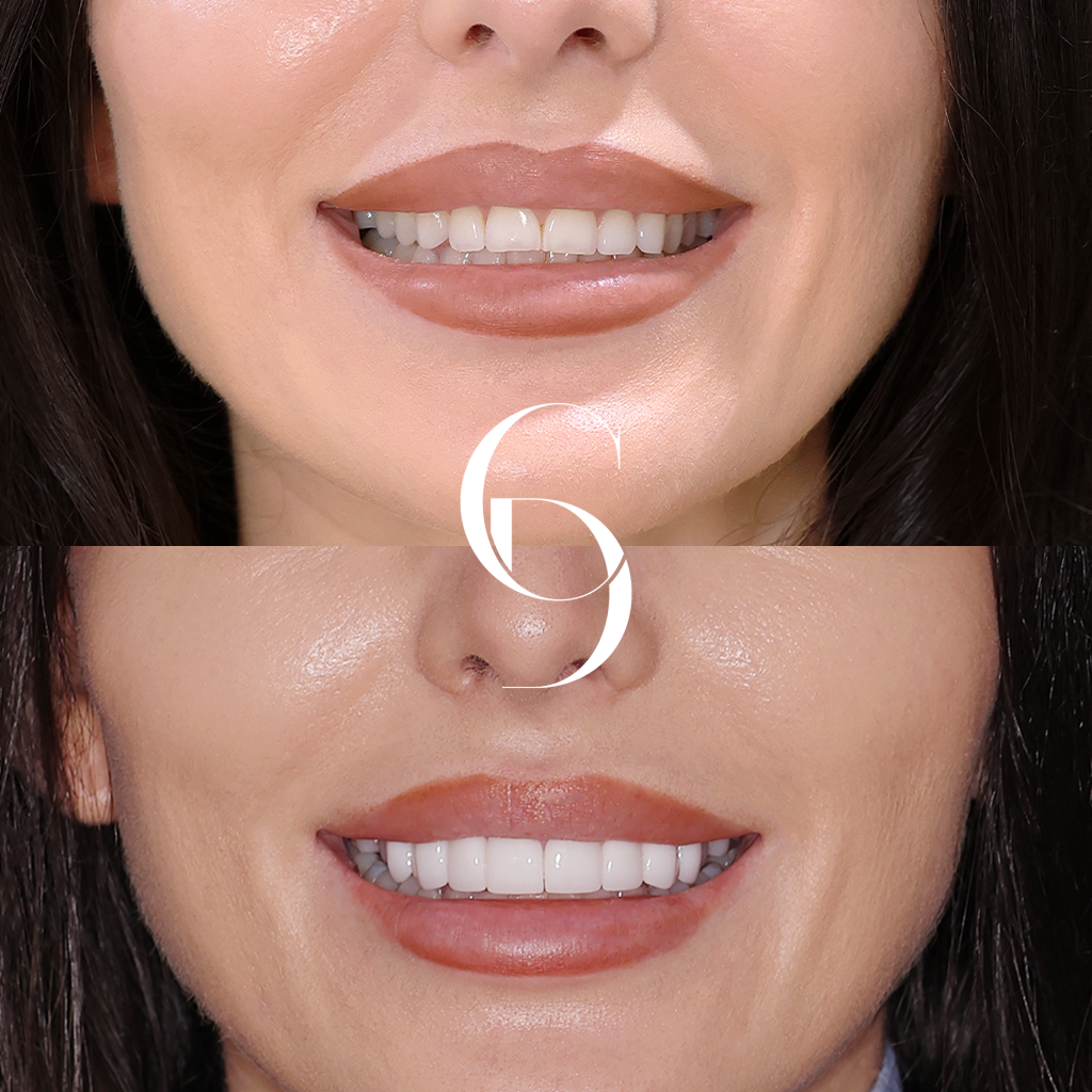 Evie's Veneers Makeover In Cosmetique Dental™