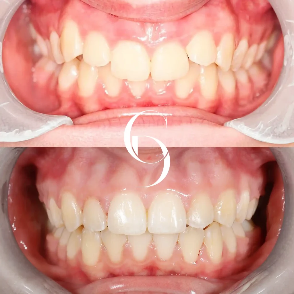 Fia's Invisalign Makeover In Cosmetique Dental™