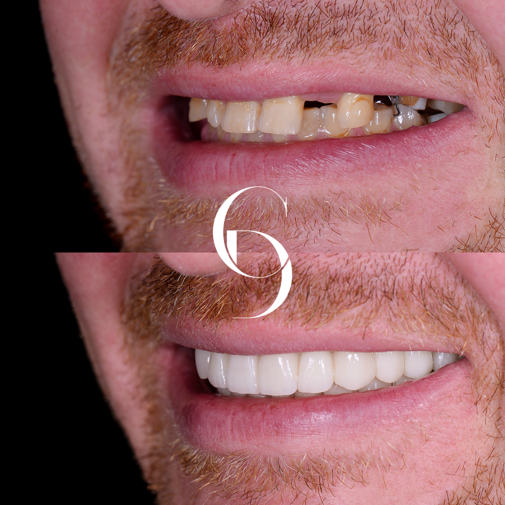 Flynn Implants Makeover In Cosmetique Dental™ Flynn's Implants Makeover In Cosmetique Dental™