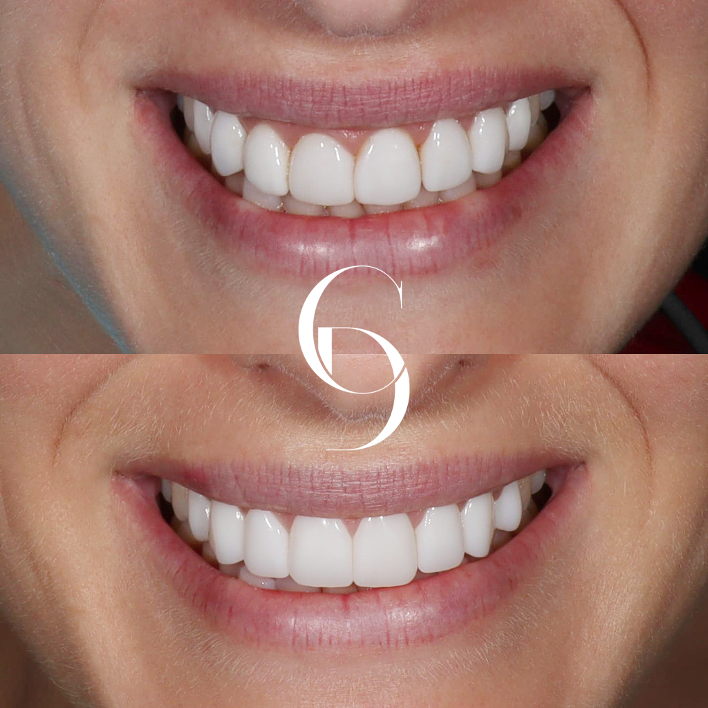 Frankie's Veneers Makeover In Cosmetique Dental™