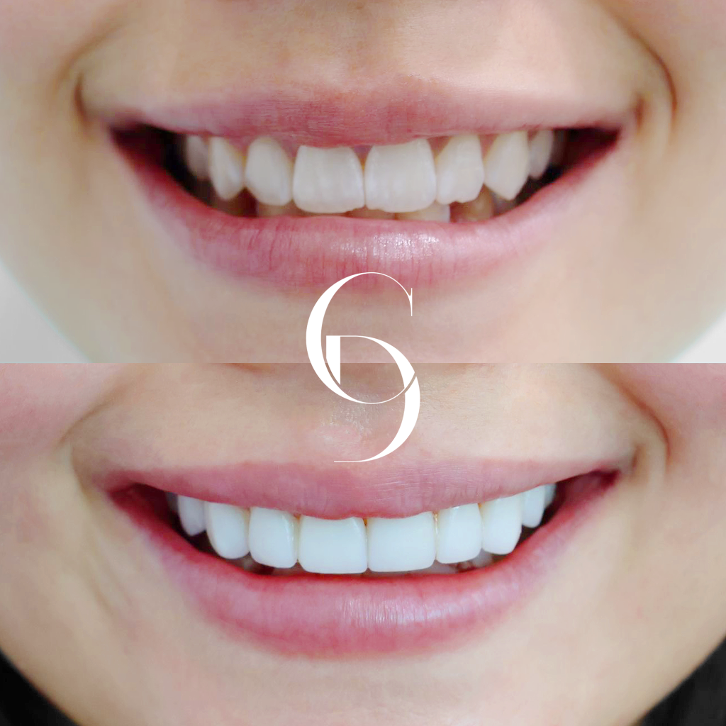 Freya Veneers Makeover In Cosmetique Dental™ Freya's Veneers Makeover In Cosmetique Dental™