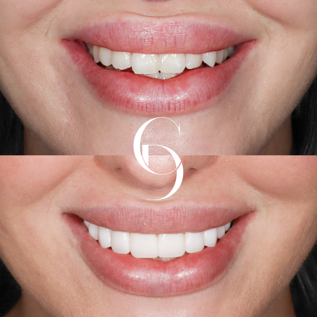 Georgia Veneers Makeover In Cosmetique Dental™ Georgia's Veneers Makeover In Cosmetique Dental™