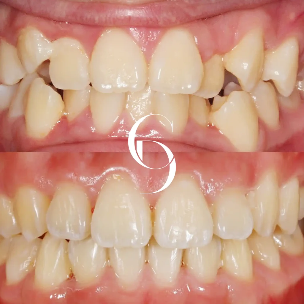 Gia's Invisalign Makeover In Cosmetique Dental™