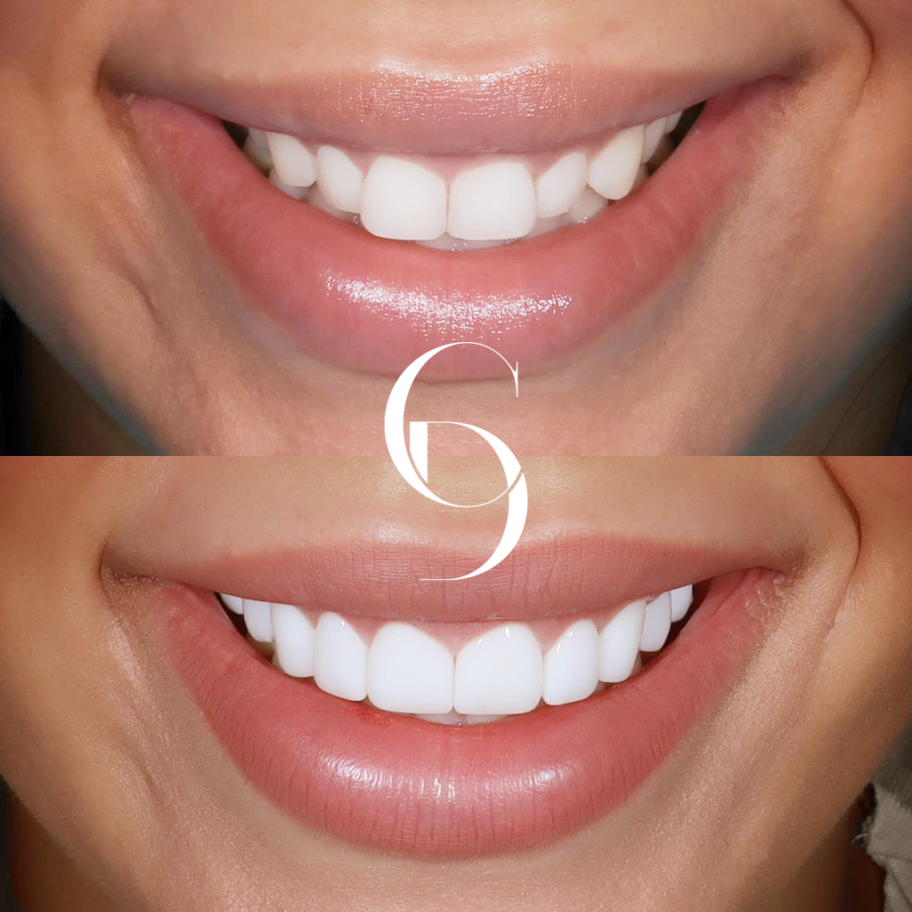 Grace Veneers Makeover In Cosmetique Dental™ Grace's Veneers Makeover In Cosmetique Dental™