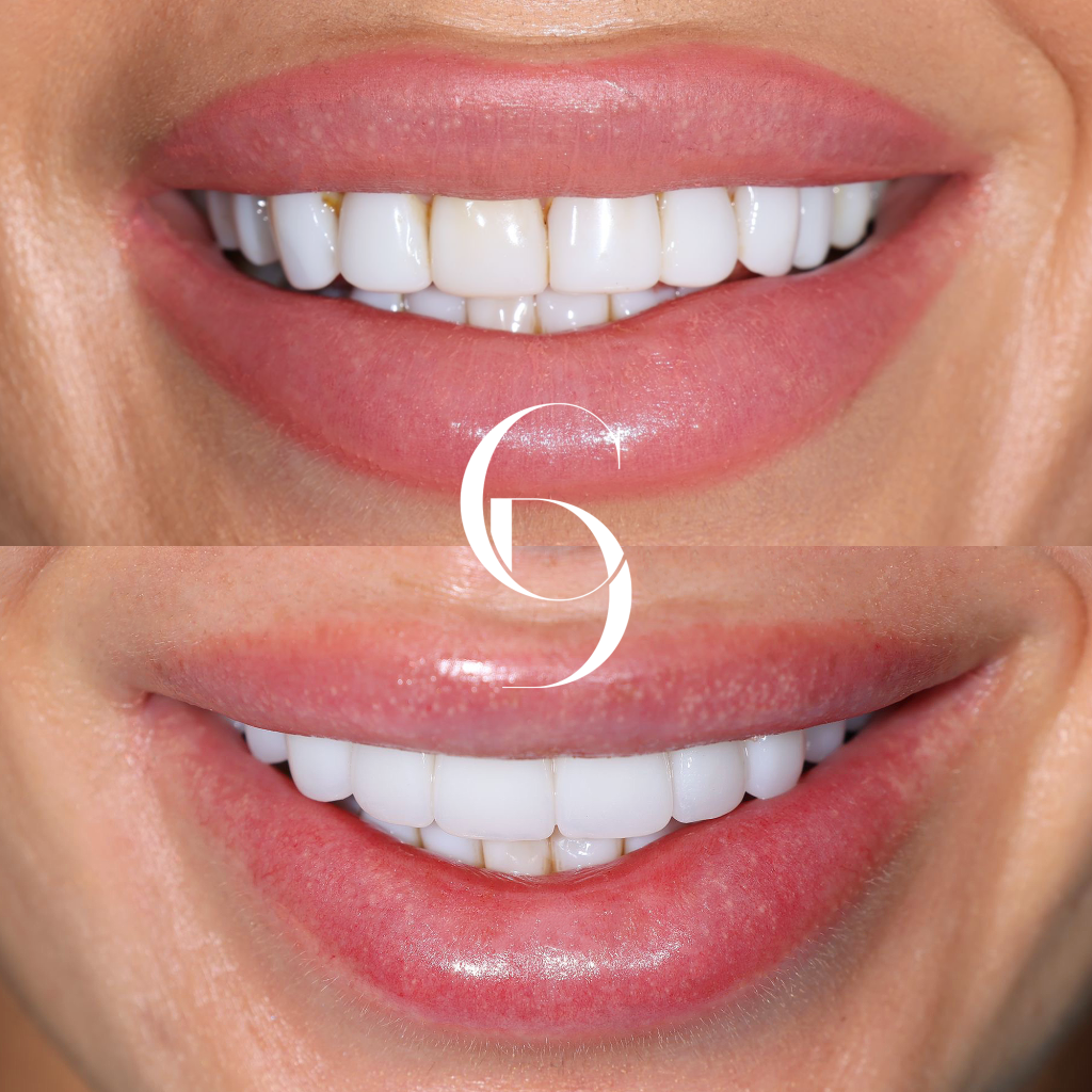 Hallie's Veneers Makeover In Cosmetique Dental™