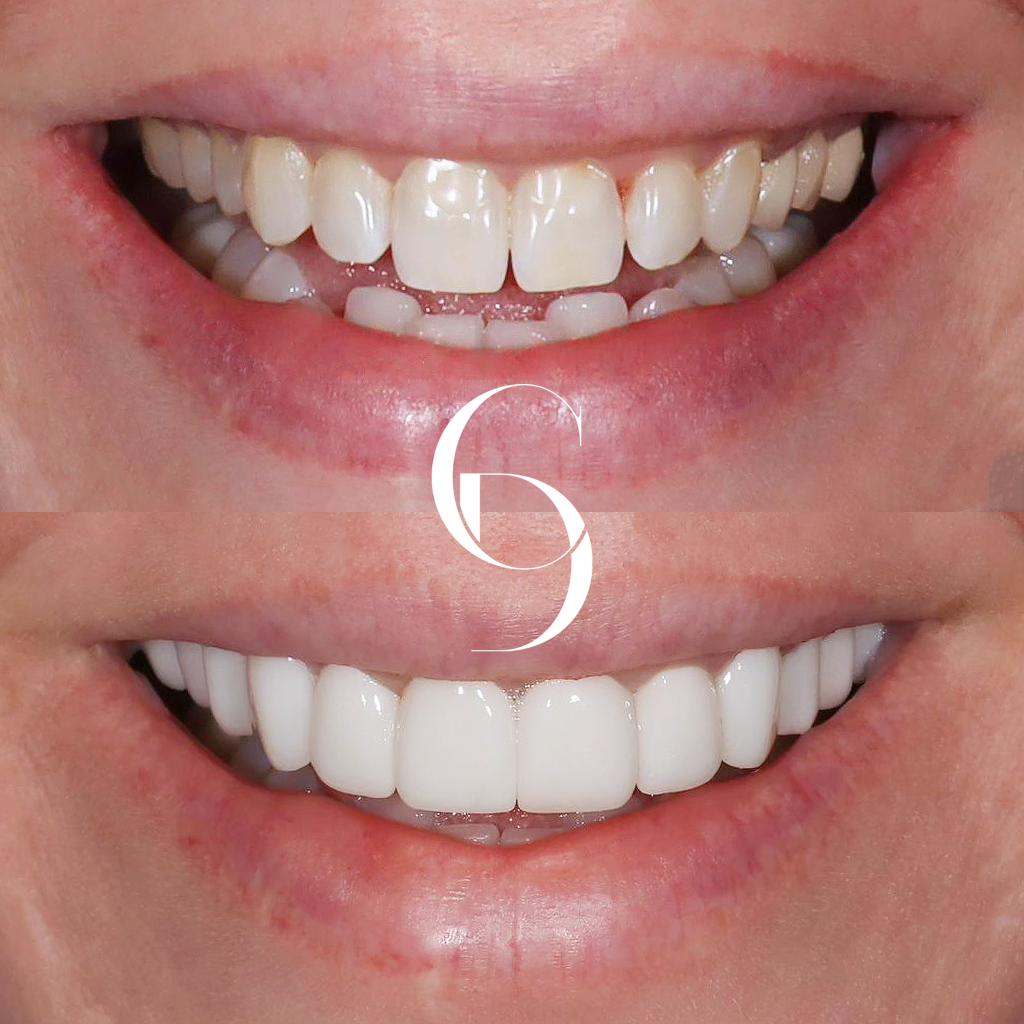Hannah Veneers Makeover In Cosmetique Dental™ Hannah's Veneers Makeover In Cosmetique Dental™