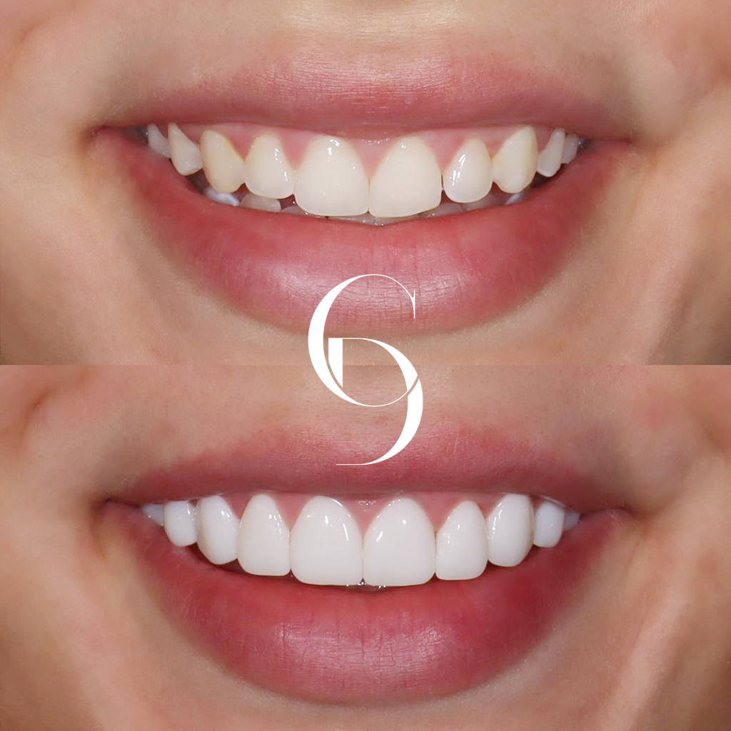 Harlow's Veneers Makeover In Cosmetique Dental™