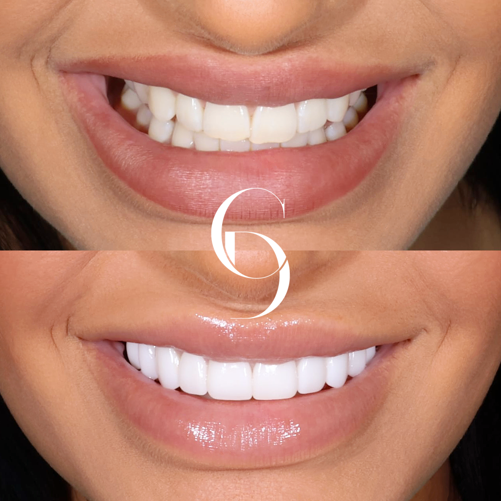 Harper's Veneers Makeover In Cosmetique Dental™