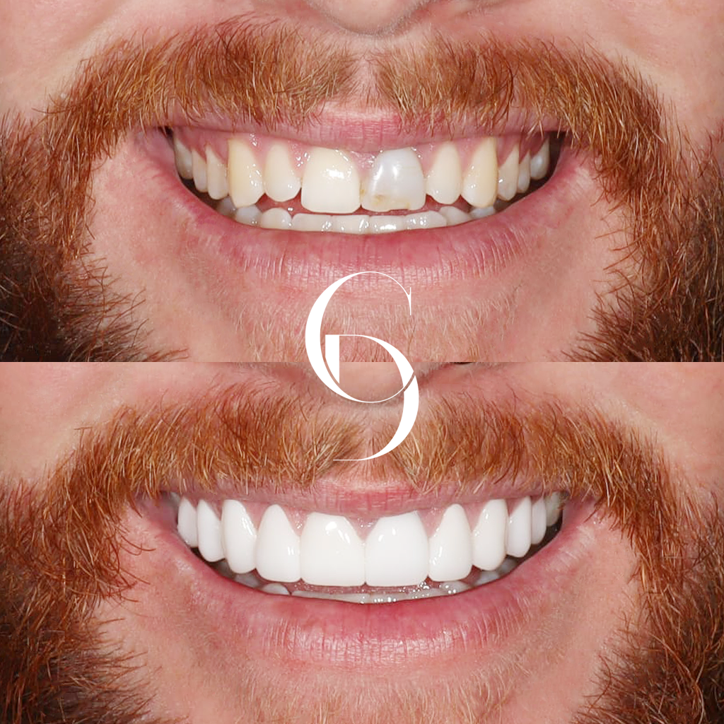 Harvey's Veneers Makeover In Cosmetique Dental™