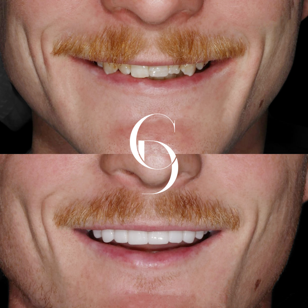 Henry's Veneers Makeover In Cosmetique Dental™