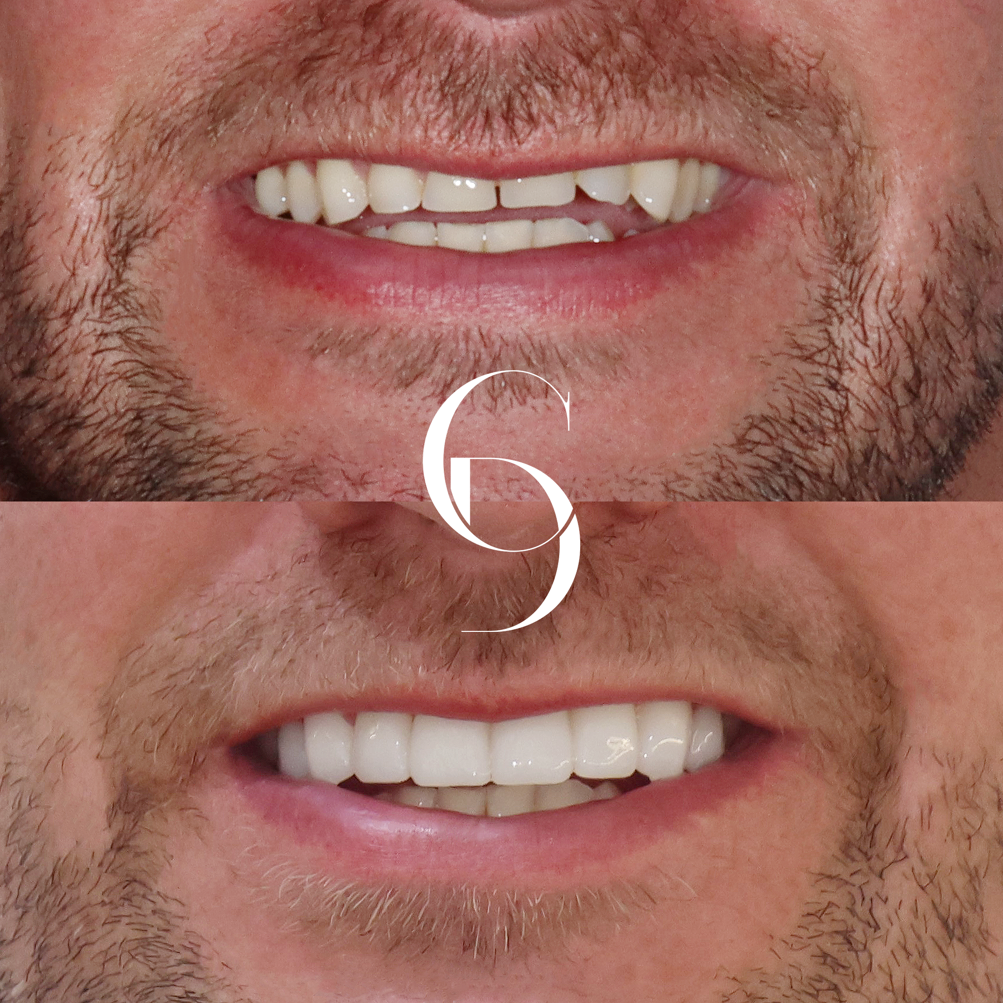 Hornsby Porcelain Veneers Ryan's Treatment Overview