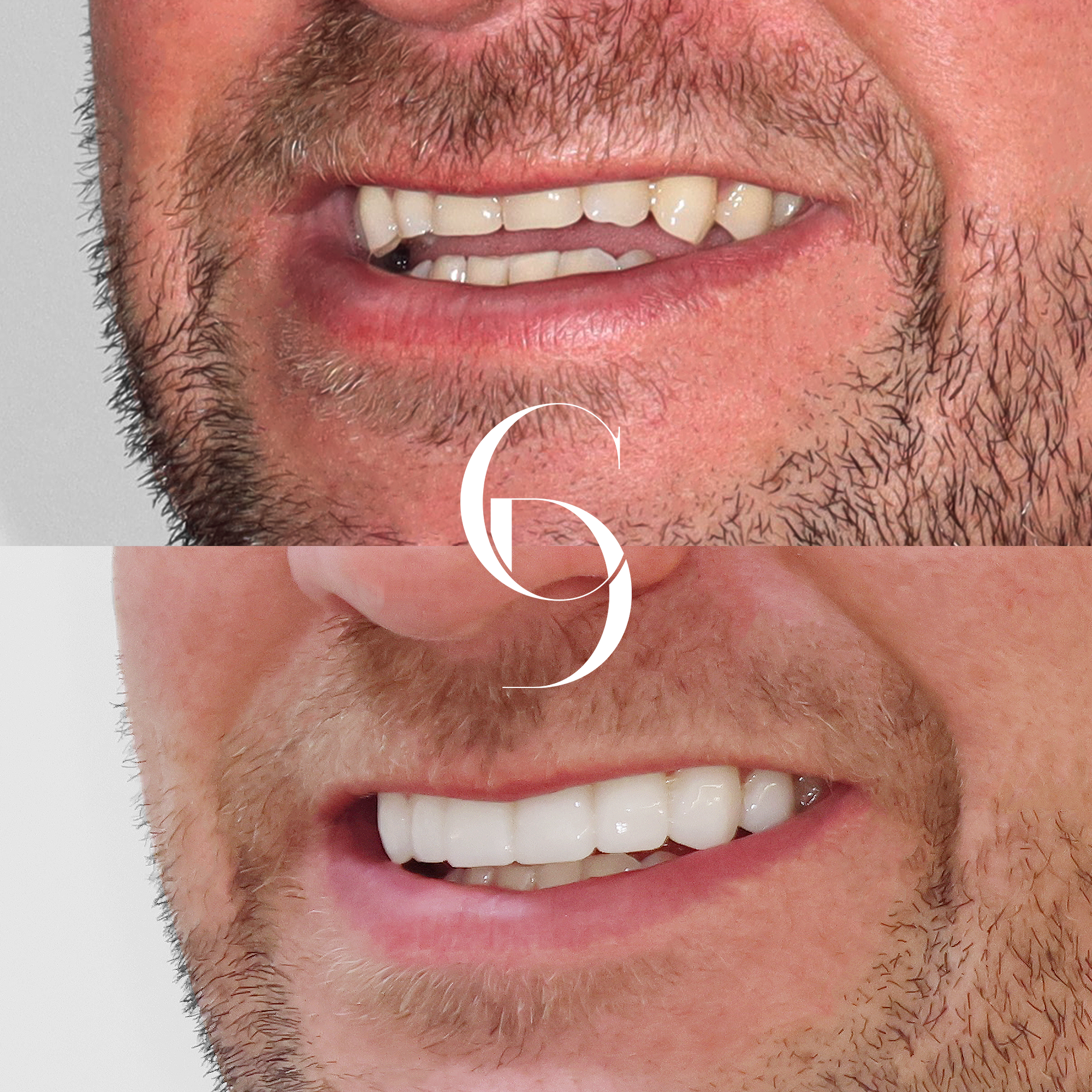 Hornsby Porcelain Veneers Ryan's Treatment Overview