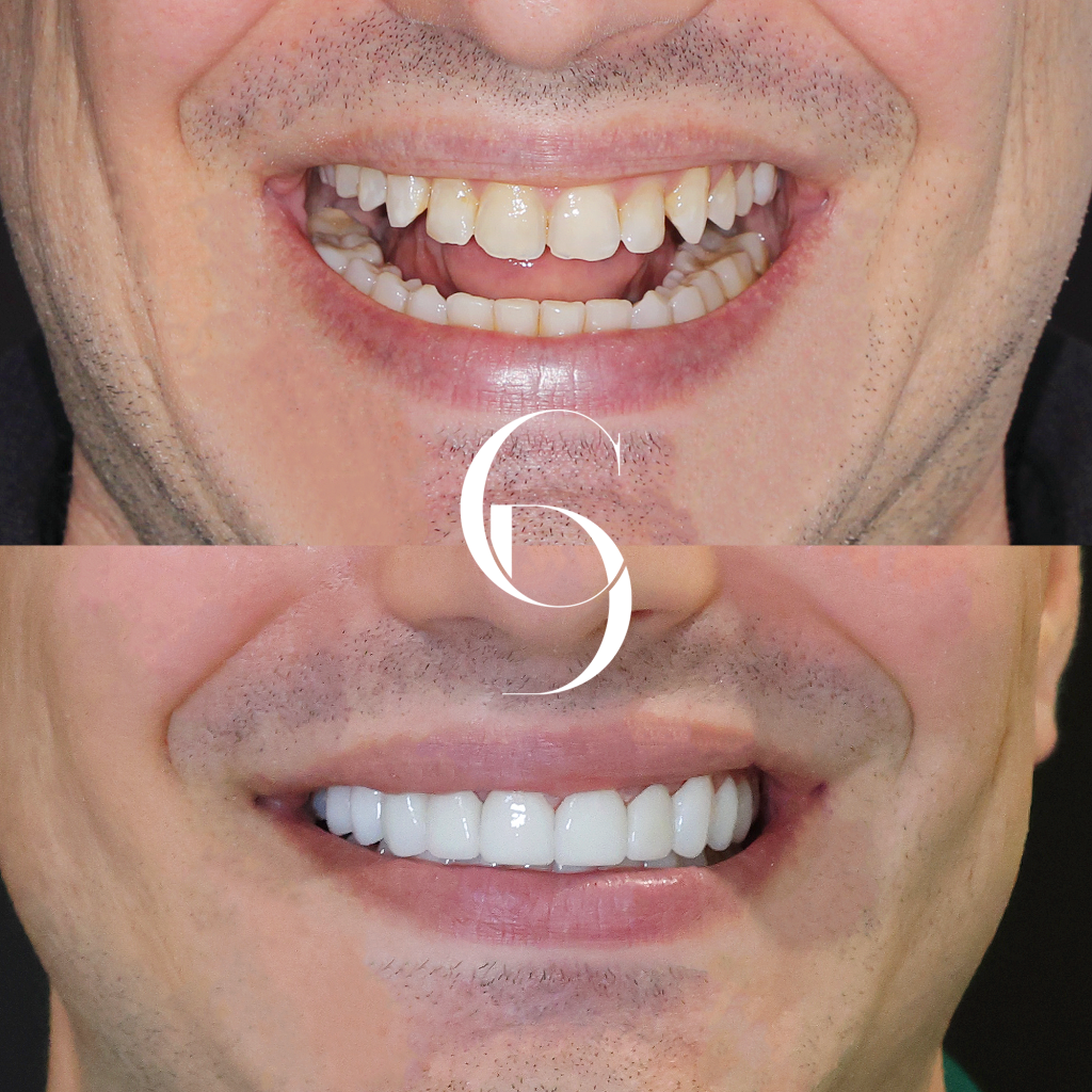 Hugo's Veneers Makeover In Cosmetique Dental™