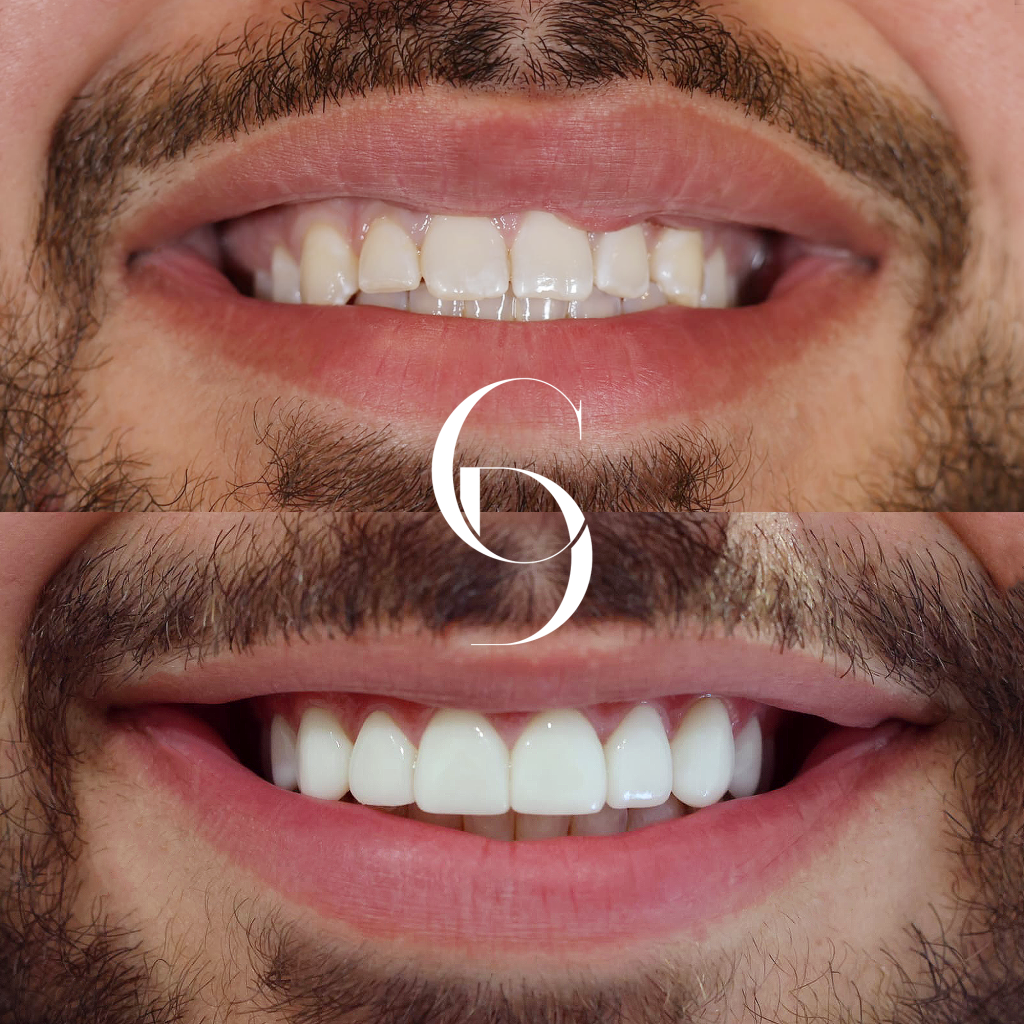 Hunter's Veneers Makeover In Cosmetique Dental™