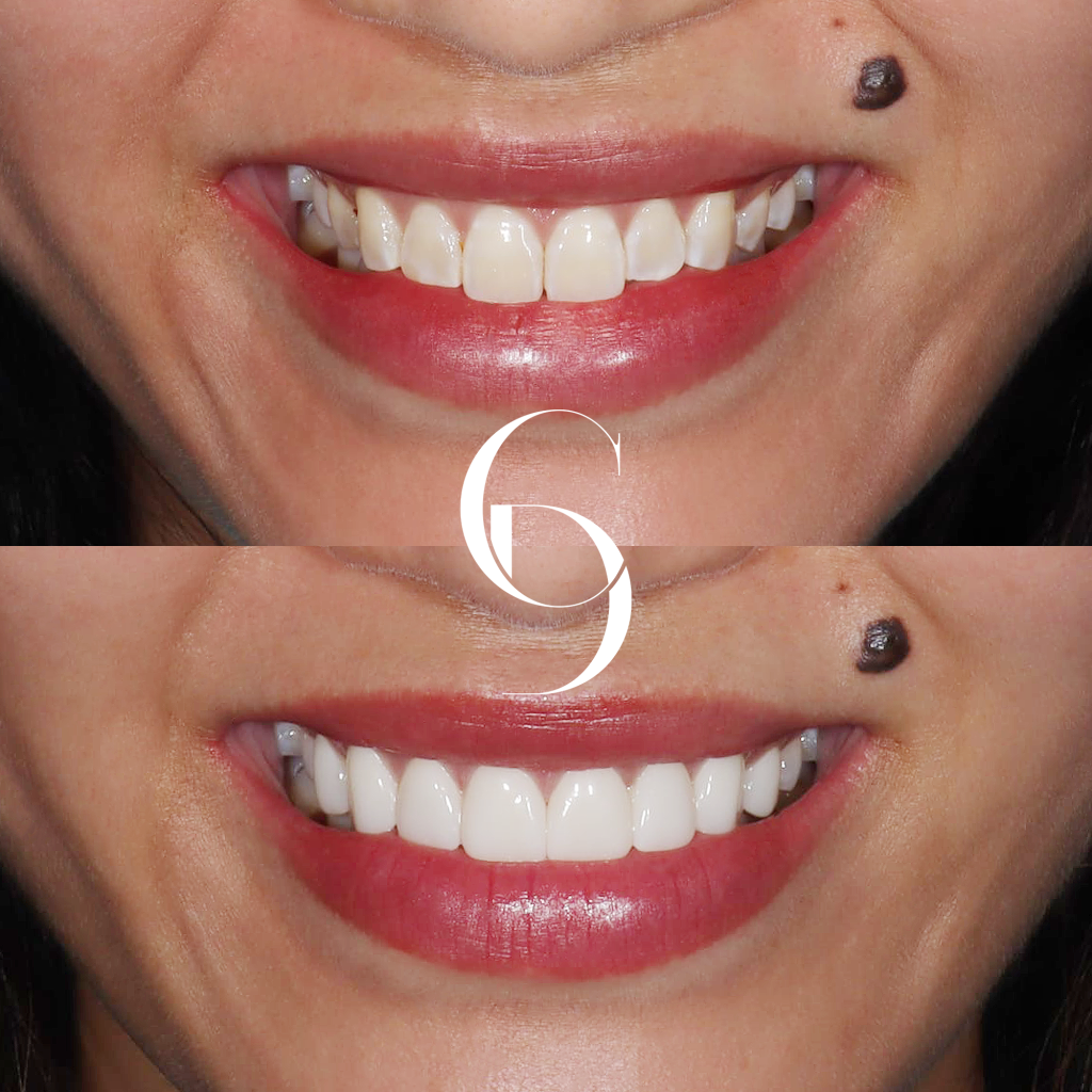 Indiana's Veneers Makeover In Cosmetique Dental™