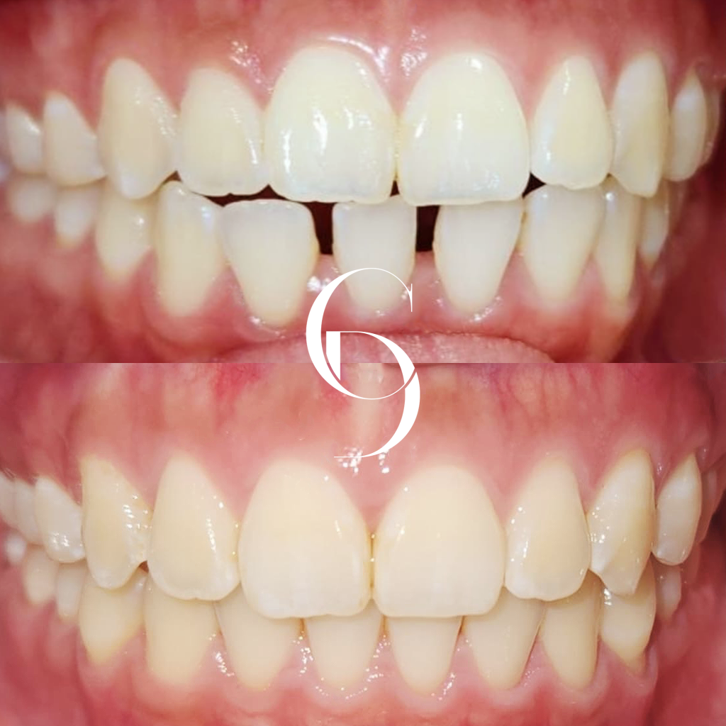 Indie's Invisalign Makeover In Cosmetique Dental™