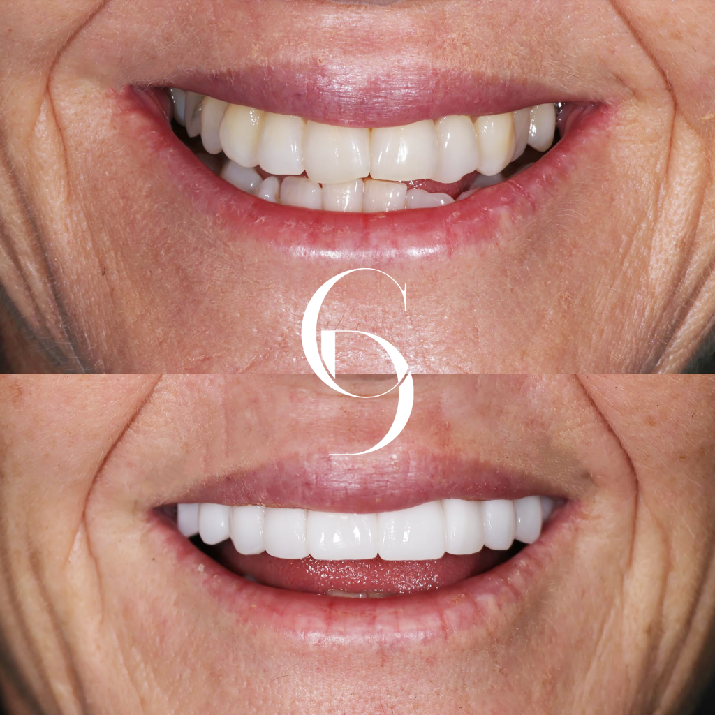 Ivy's Veneers Makeover In Cosmetique Dental™