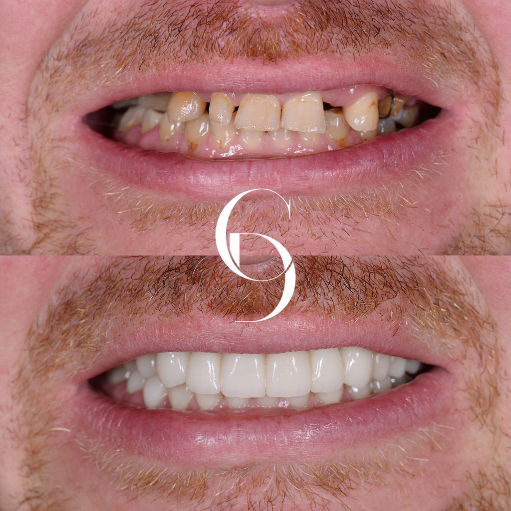 Jack Implants Makeover In Cosmetique Dental™ Jack's Implants Makeover In Cosmetique Dental™