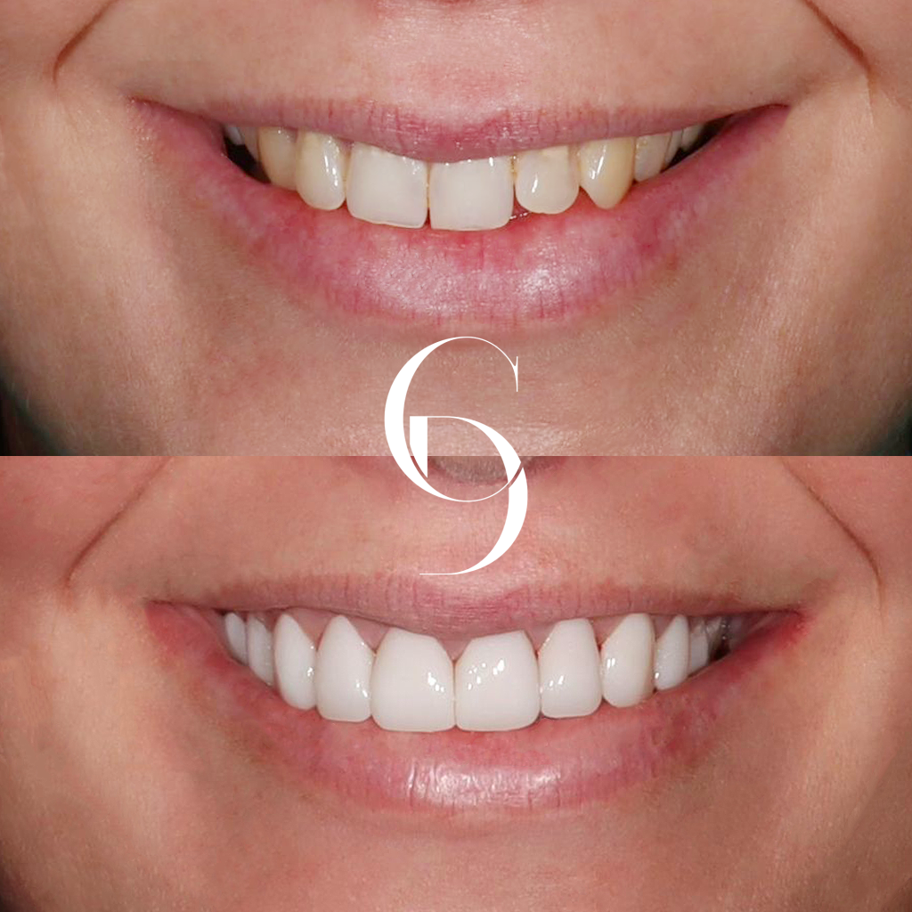 Jade's Veneers Makeover In Cosmetique Dental™