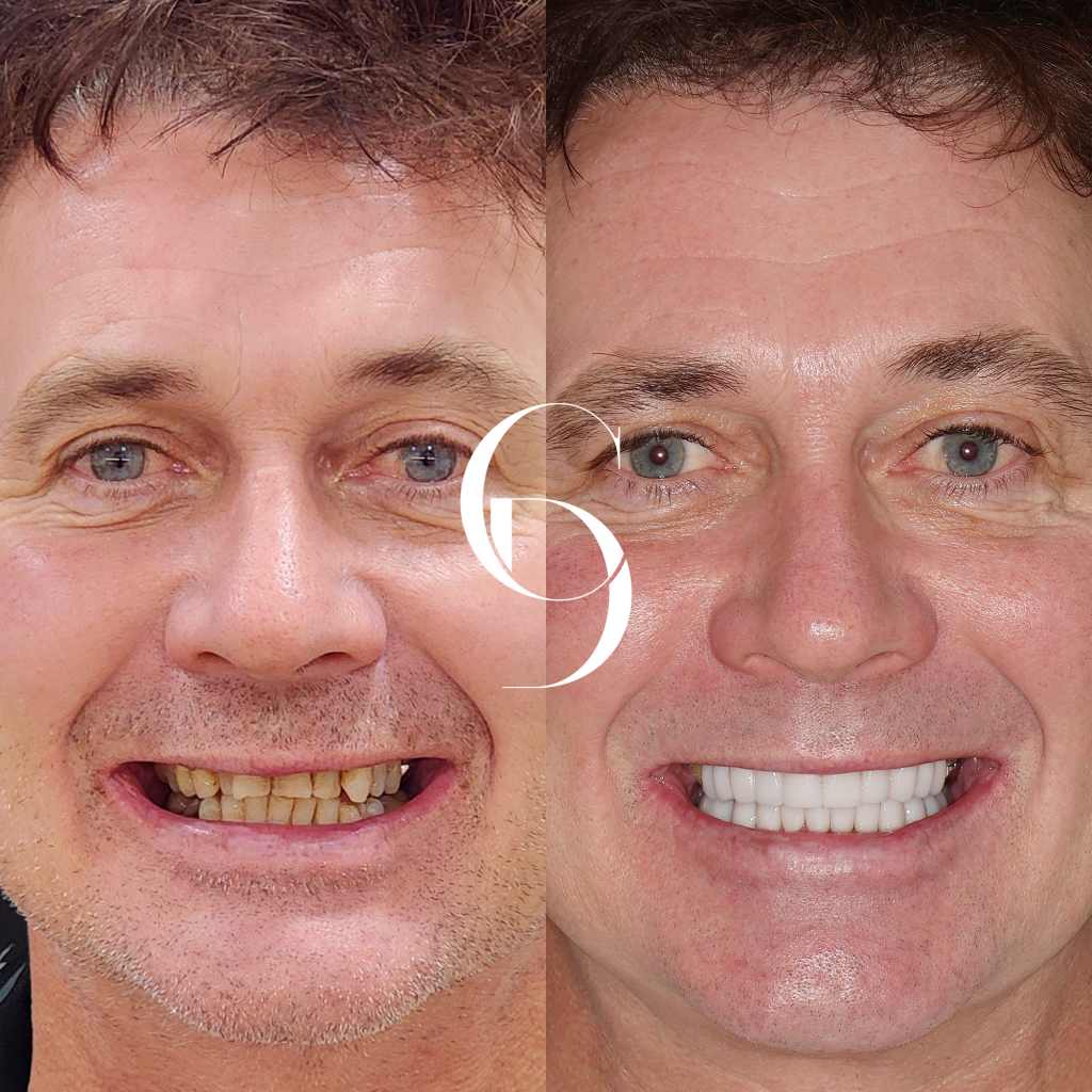 Jason's Porcelain Veneers A Canberra Smile Enhancement