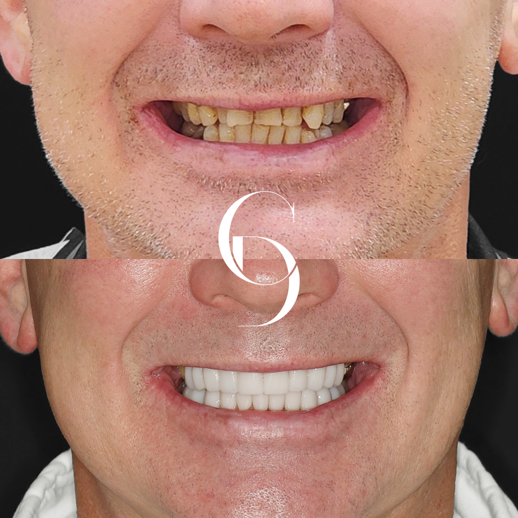 Jason's Porcelain Veneers A Canberra Smile Enhancement