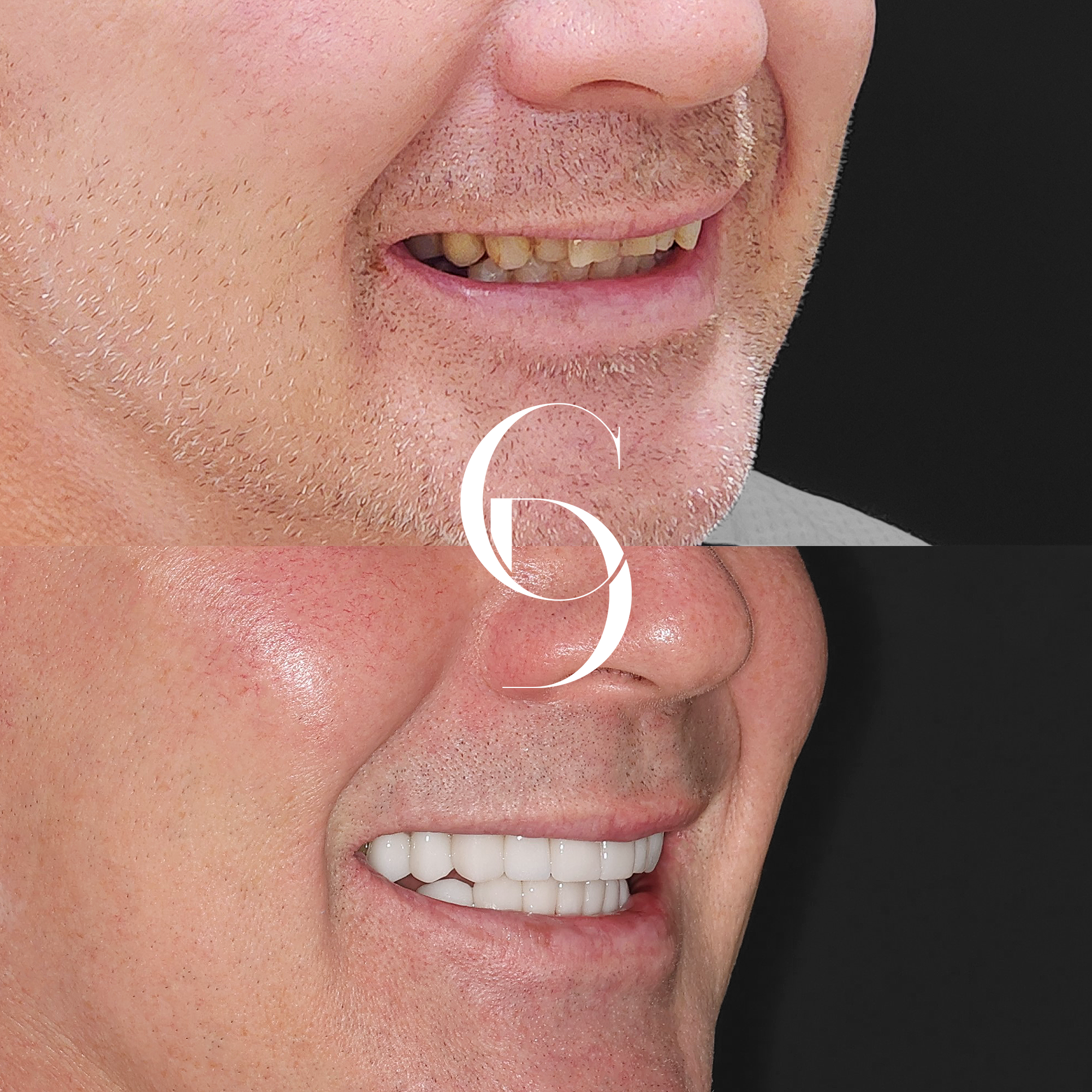 Jason's Porcelain Veneers A Canberra Smile Enhancement