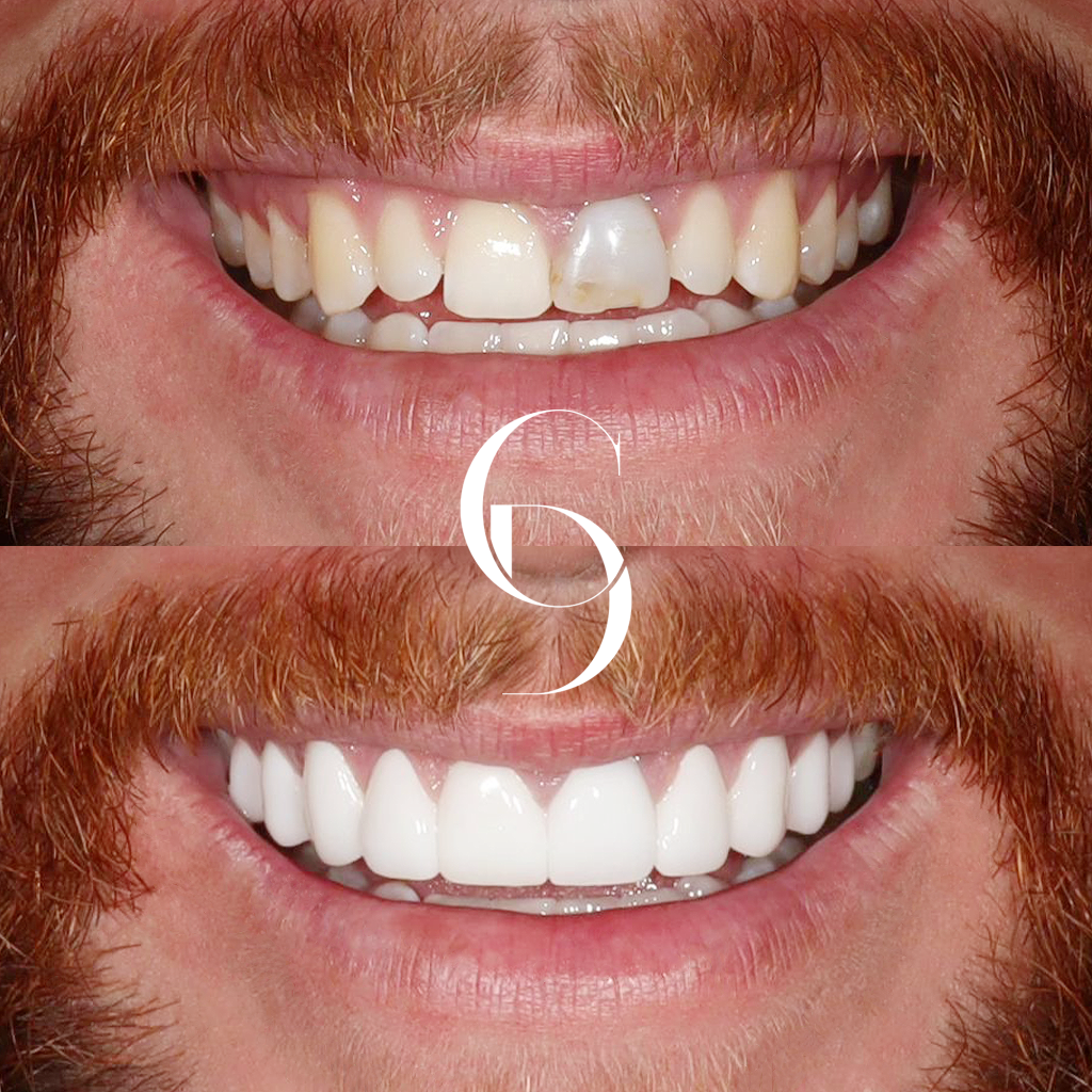 Jaxon's Veneers Makeover In Cosmetique Dental™