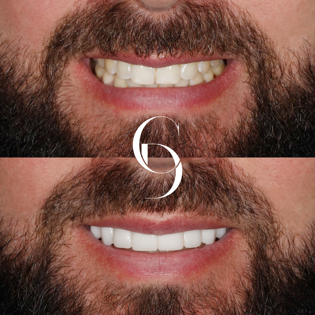 Jesse's Veneers Makeover In Cosmetique Dental™