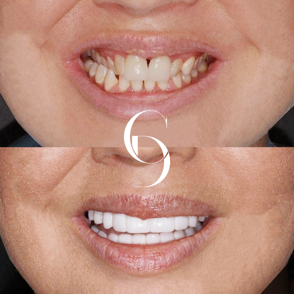 Jessica's Smile Enhancement with Porcelain Veneers in Macquarie Park