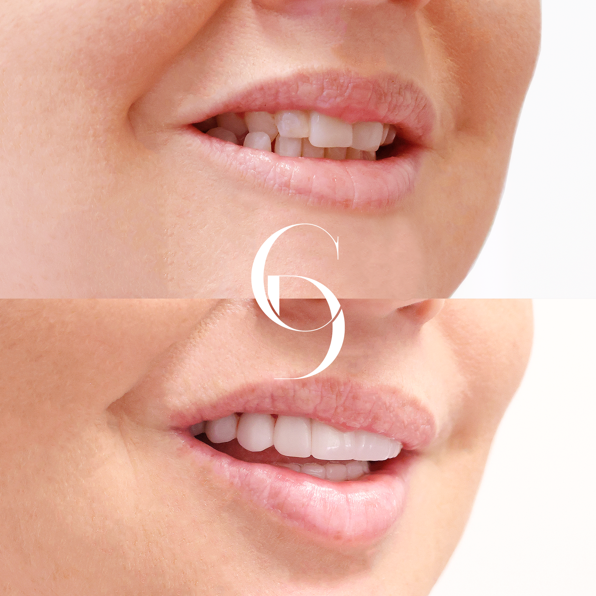 Jessica's Smile Enhancement with Porcelain Veneers in Macquarie Park