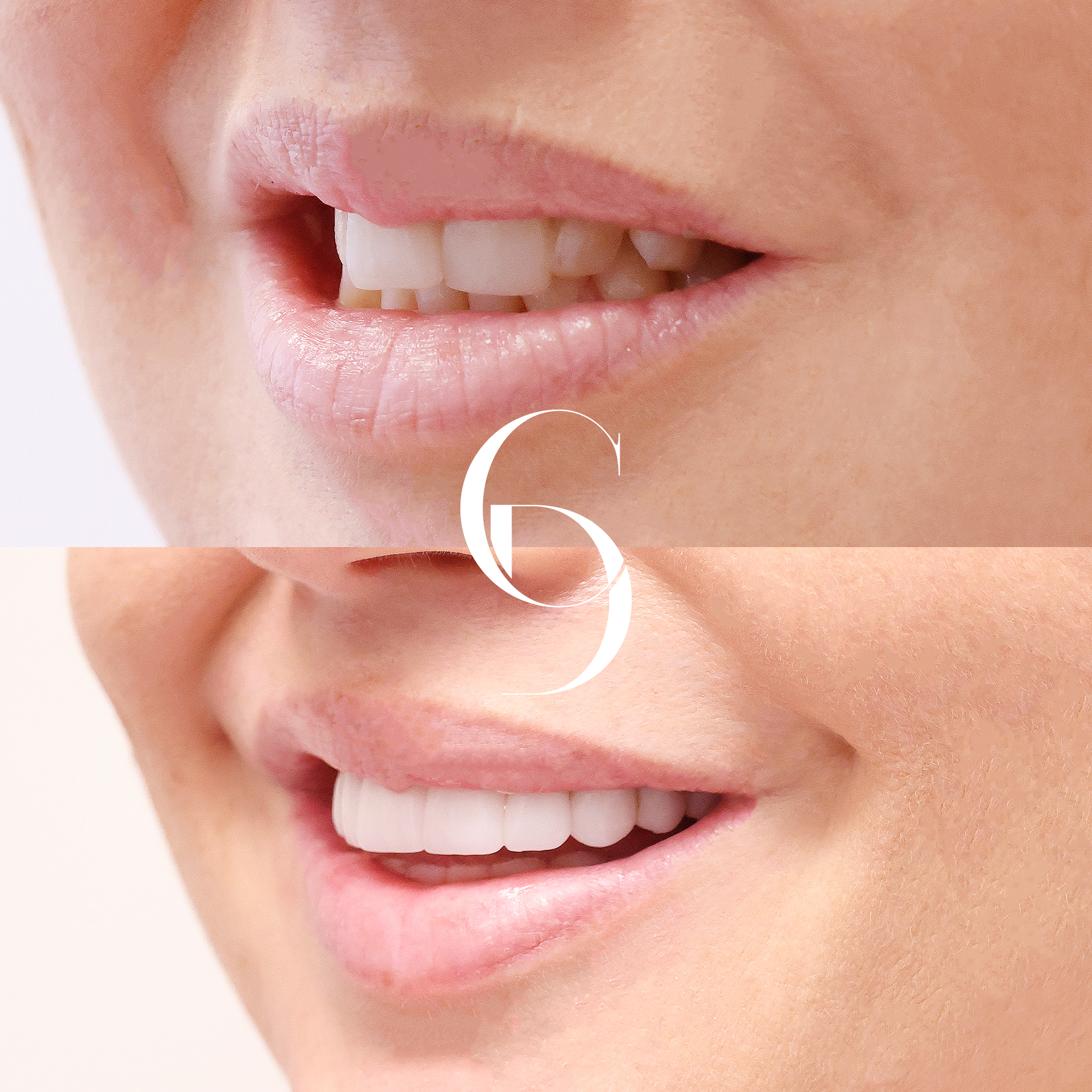 Jessica's Smile Enhancement with Porcelain Veneers in Macquarie Park