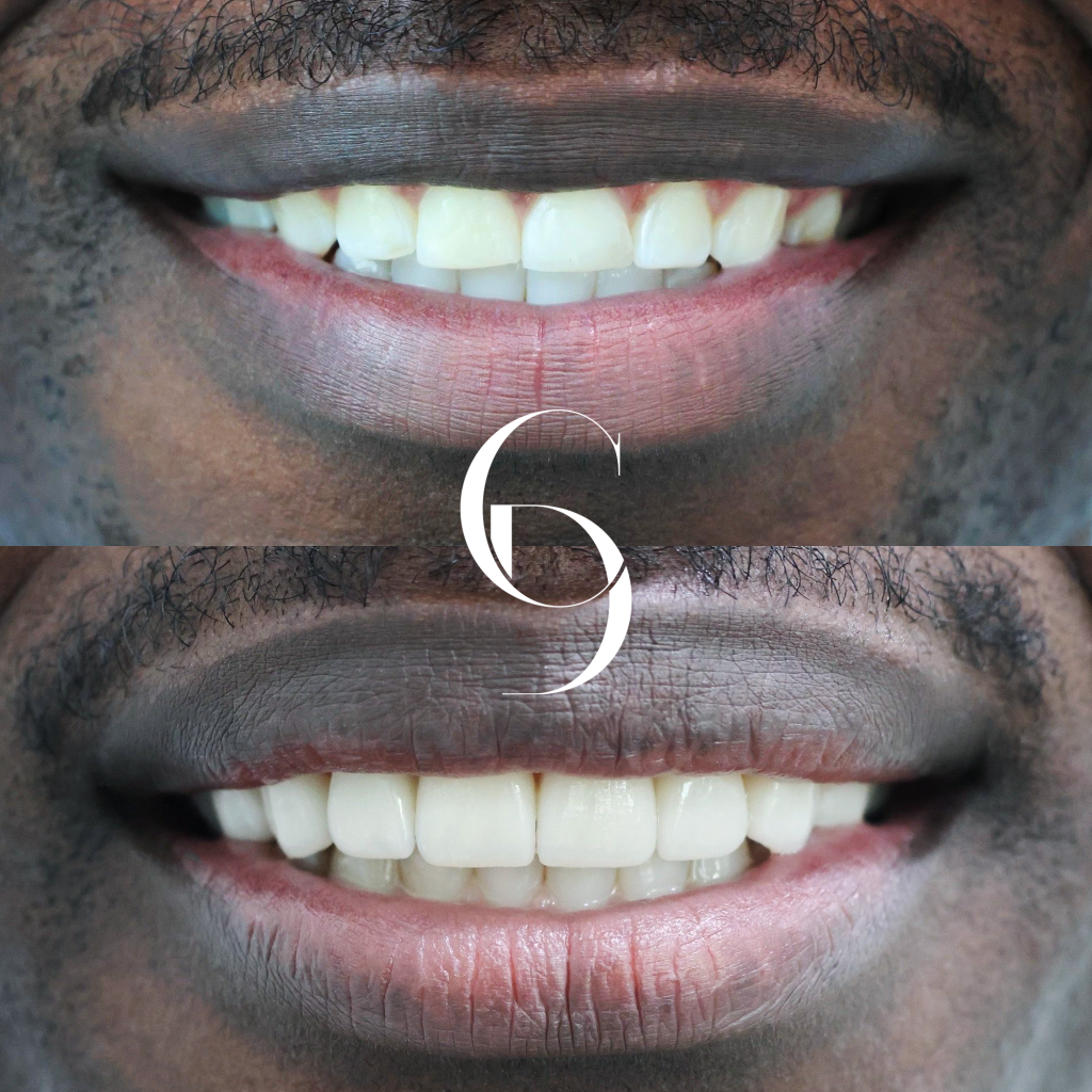 Kai's Veneers Makeover In Cosmetique Dental™