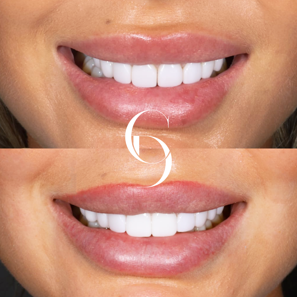 Kasey's Radiant Smile A Porcelain Veneers Journey In Bondi Junction