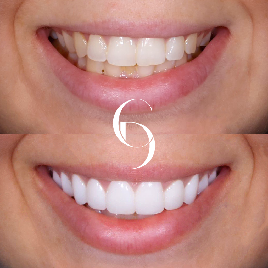 Kiara's Veneers Makeover In Cosmetique Dental™