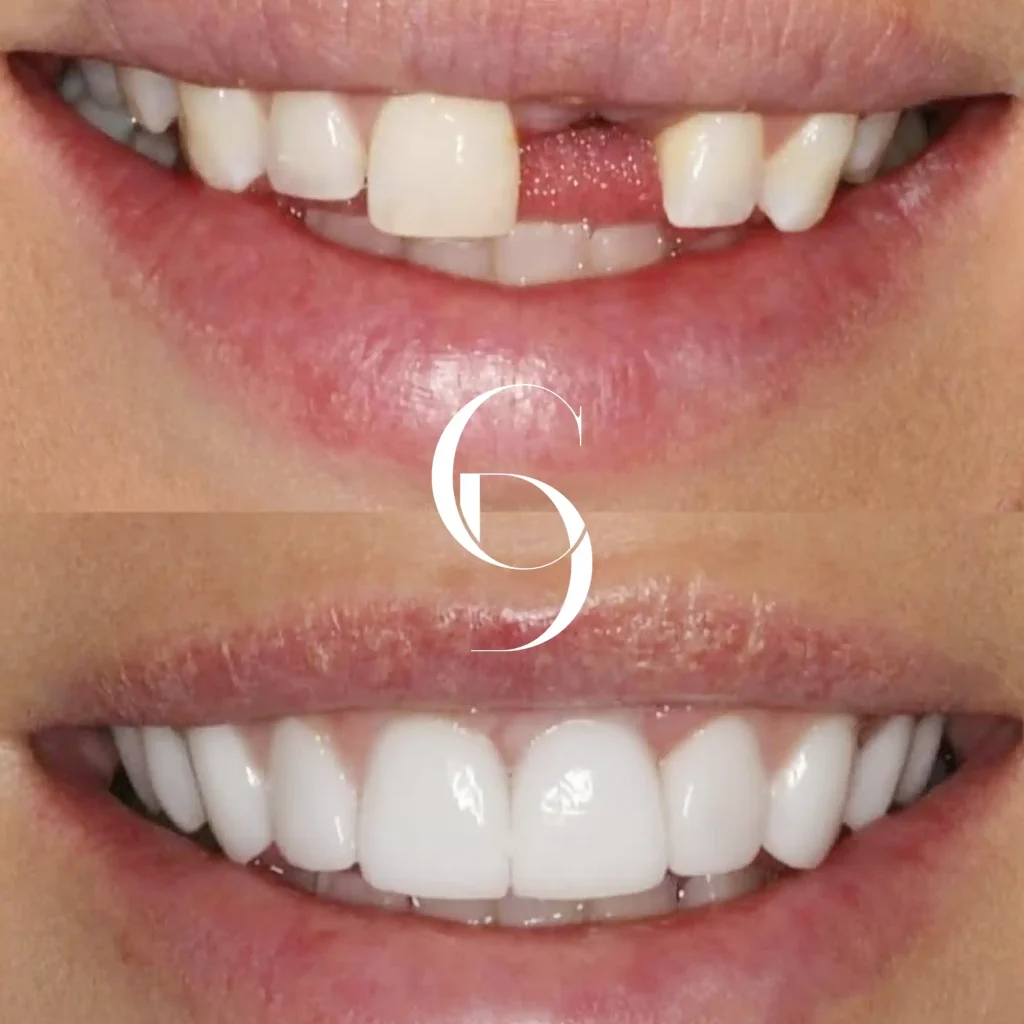 Kyle's Dental Implants In Cosmetique Dental™