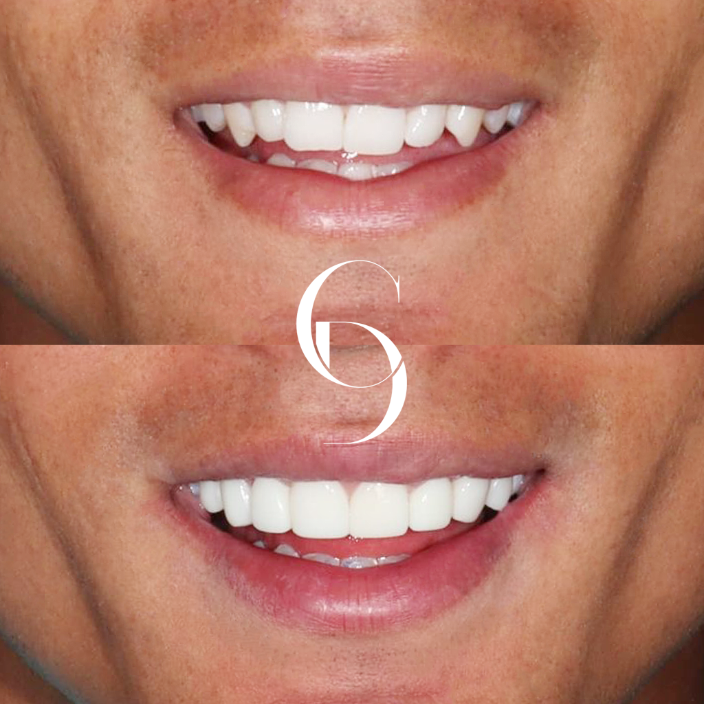 Lachlan's Veneers Makeover In Cosmetique Dental™