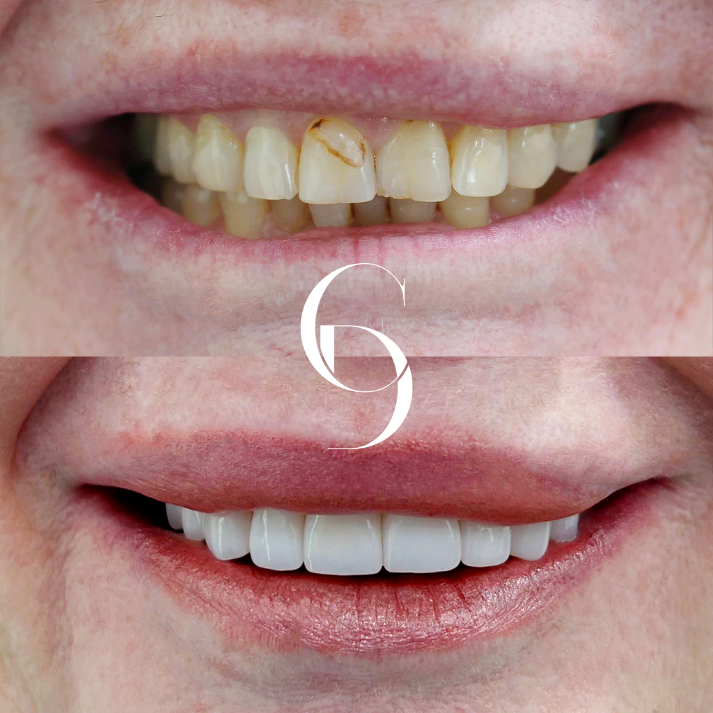 Layla's Veneers Makeover In Cosmetique Dental™