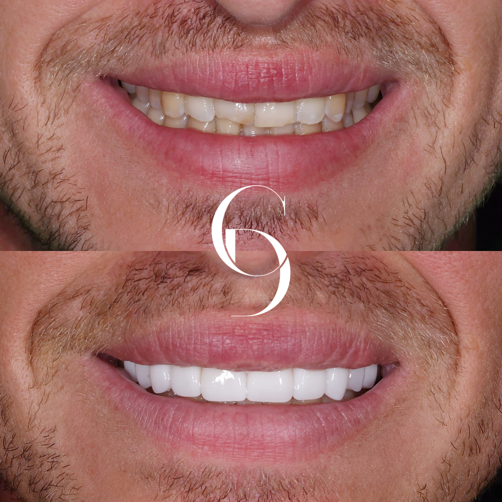 Levi's Veneers Makeover In Cosmetique Dental™