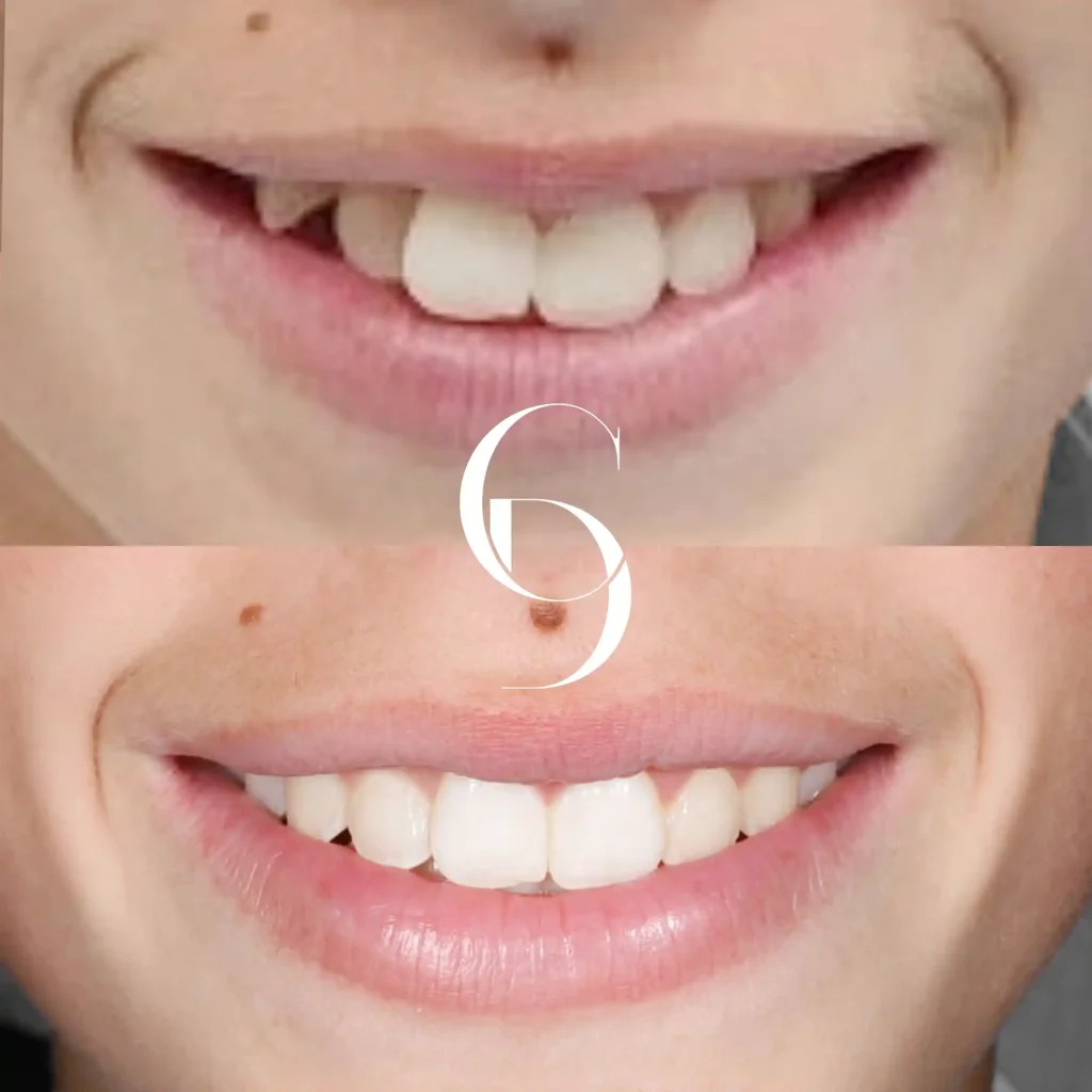 Lia’s Orthodontics Makeover In Cosmetique Dental™ Lia's Orthodontics Makeover In Cosmetique Dental™