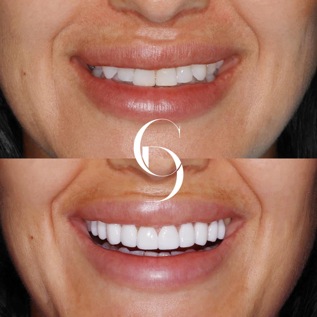 Lily Veneers Makeover In Cosmetique Dental™ Lily's Veneers Makeover In Cosmetique Dental™