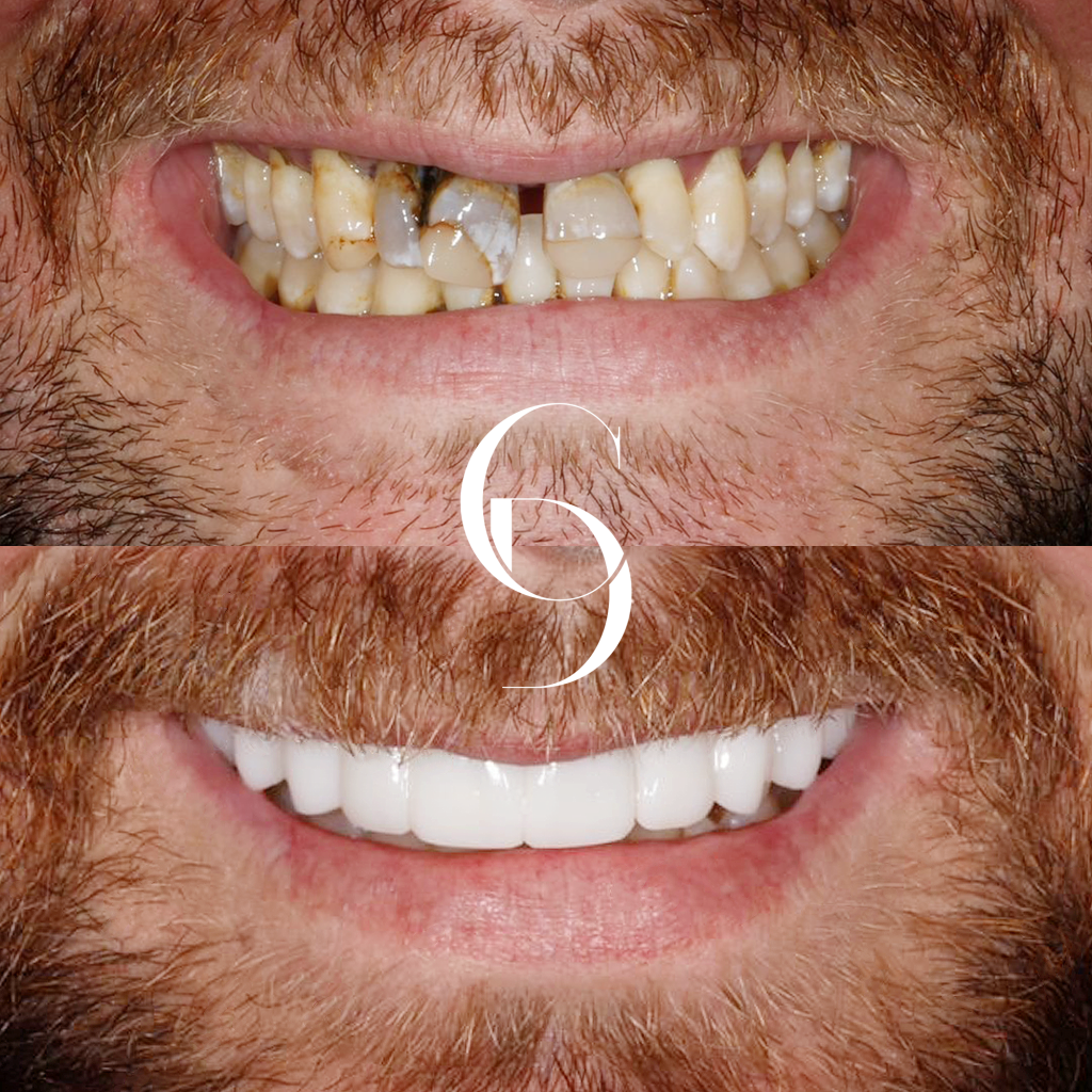 Lucas All On X Makeover In Cosmetique Dental™ Lucas' All-On-X Makeover In Cosmetique Dental™